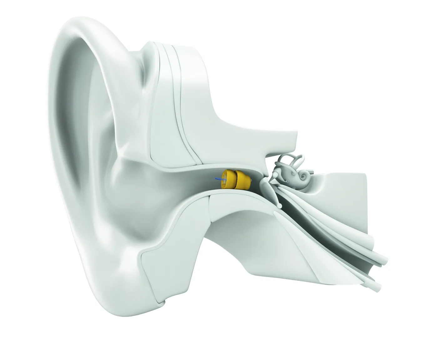 A cutaway of the ear showing a Phonak Lyric device sitting deep in the ear canal, close to the eardrum.